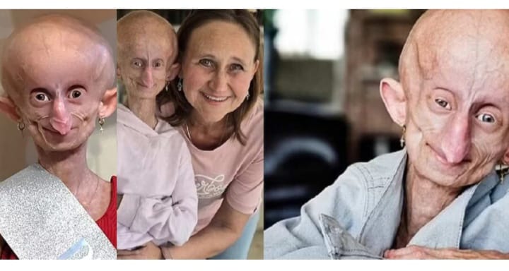 ബാല്യത്തിൽ തന്നെ വൃദ്ധയായി!; അന്ത്യം 19–ാം വയസിൽ